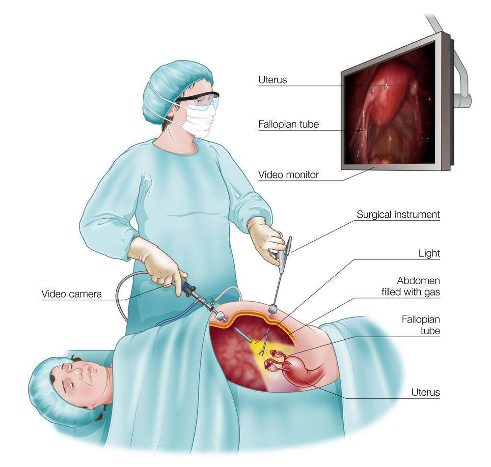 Laparoscopic surgery – safe operations through small incisions